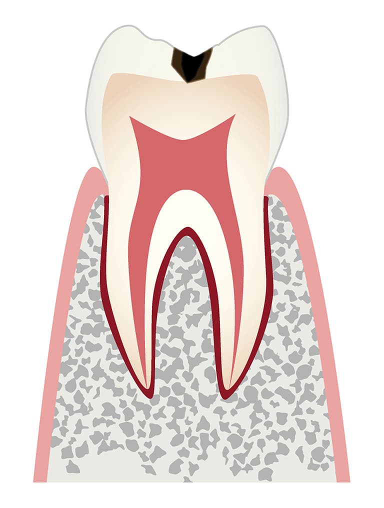 初期の虫歯のイラスト