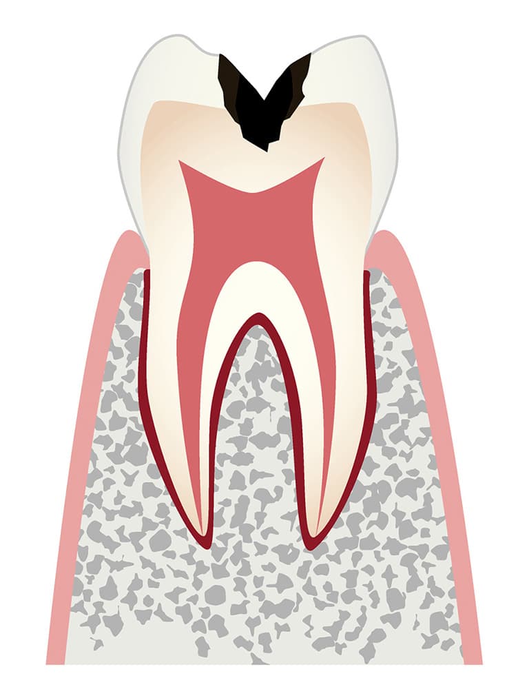 歯の内部まで進行した虫歯のイラスト
