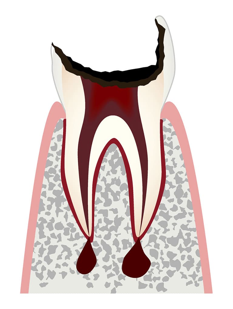 歯の根（歯質）が失われた歯のイラスト