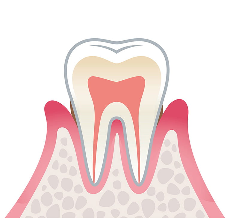 軽度歯周病のイラスト