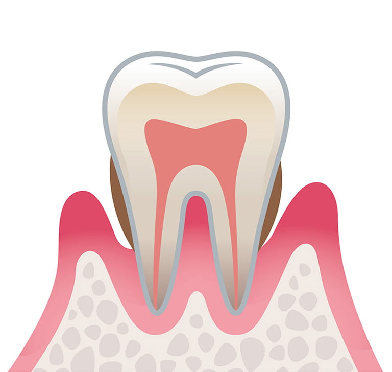 中等度歯周病のイラスト