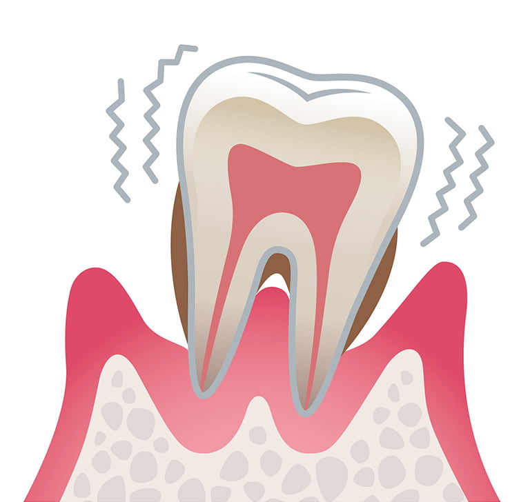 重度歯周病のイラスト